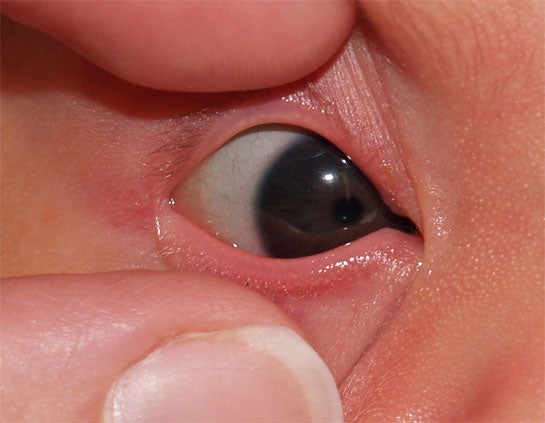 Eye normal Janelle Aby, MD, Stanford University Medical Center.jpg